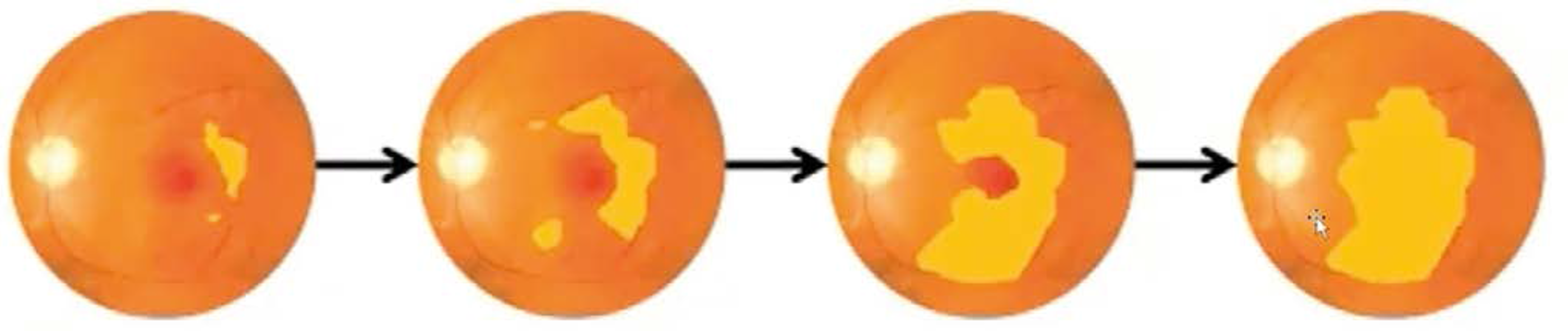 Diagram Of Atrophy Spreading